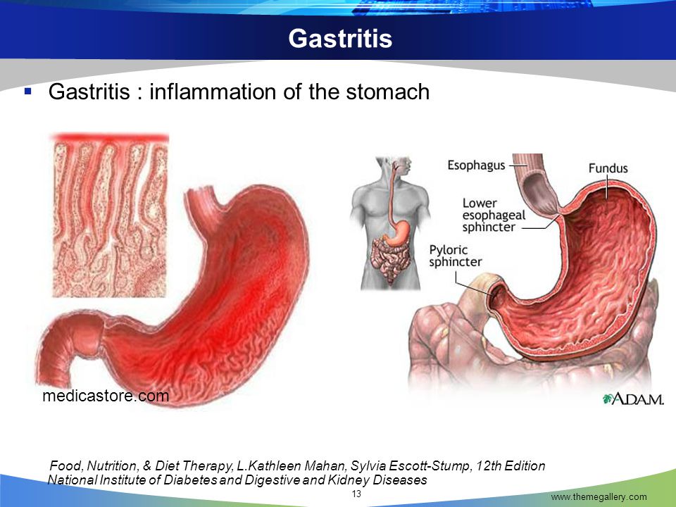 Tratamiento gastritis cronica